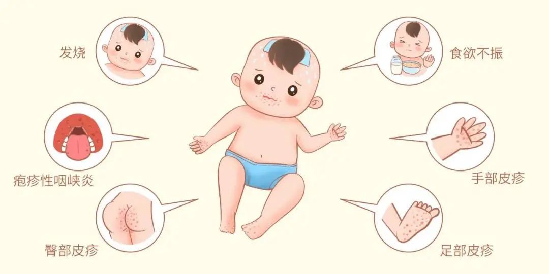 手足口病临床表现.jpg 手足口病临床表现.jpg